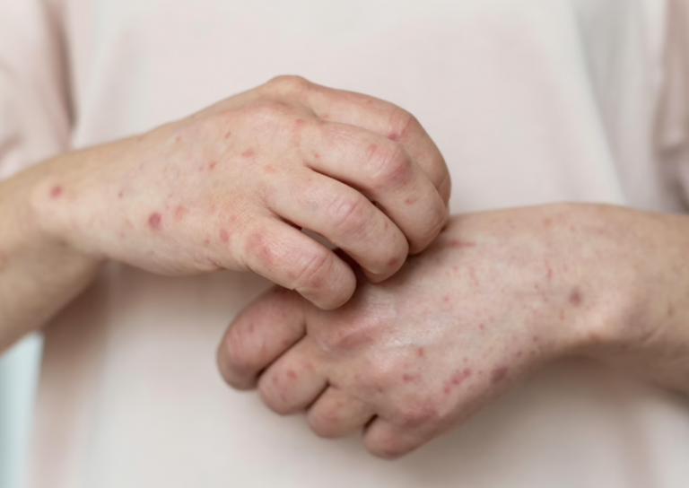 De los casos sospechosos de viruela del mono en Querétaro, el 100% corresponden a hombres y están en un rango de 22 a 54 años.