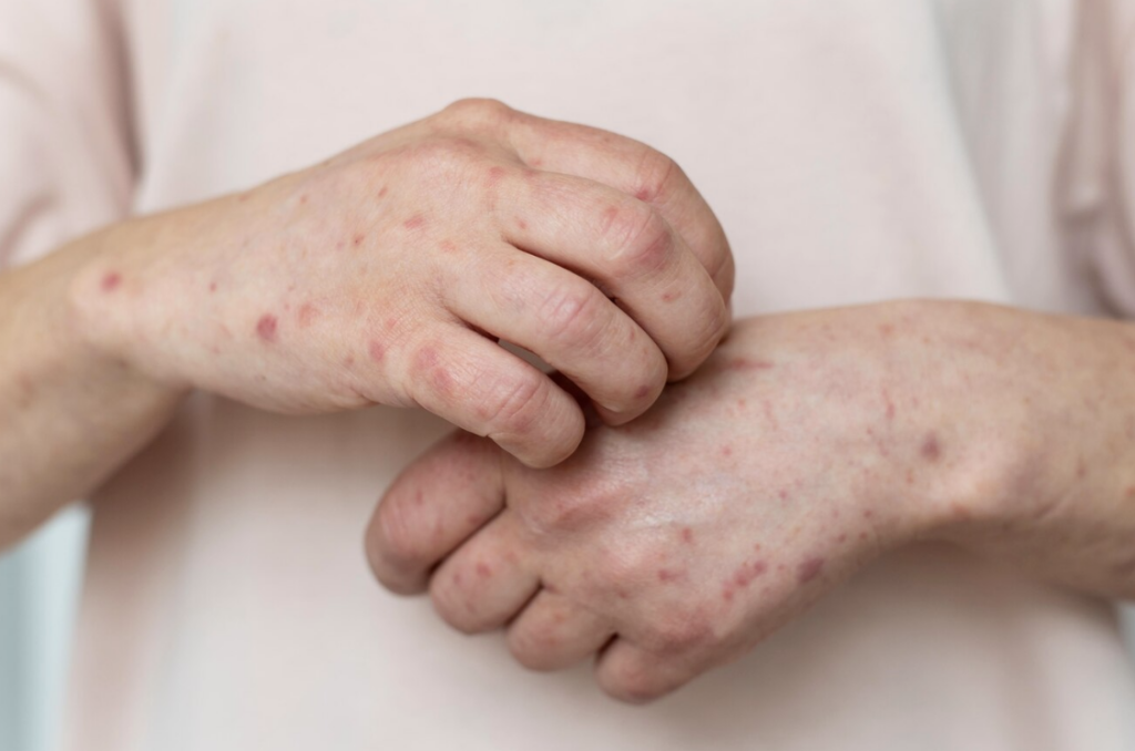 Hasat el momento no hay casos positivos de sarampión en el estado, solo sospechosos.