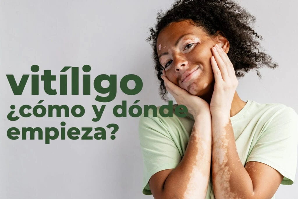 vitiligo